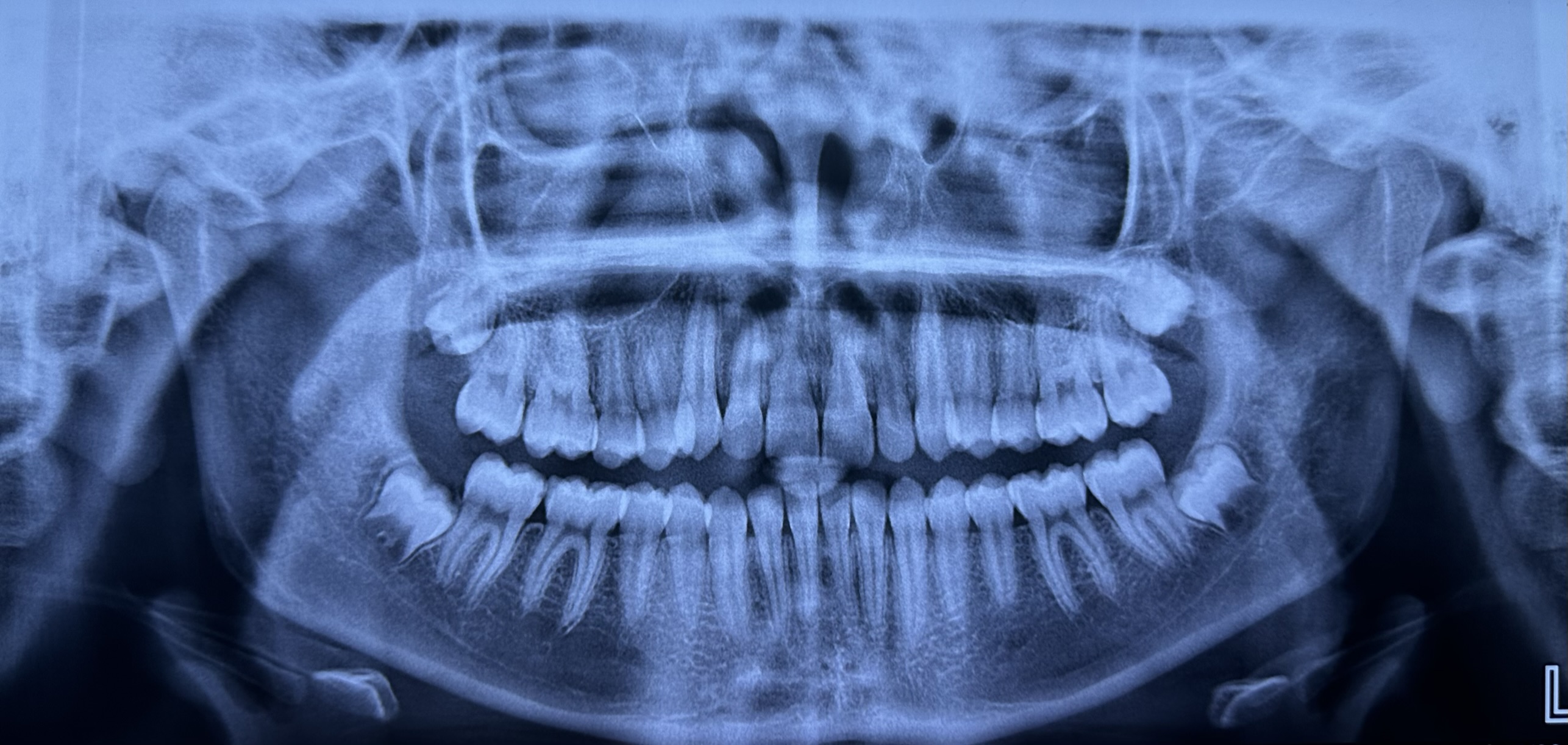 Extracción de terceros molares — Smile Implant Center